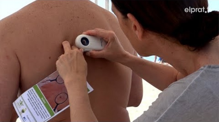 Prevenció i conscienciació a la platja sobre els riscos de l'exposició excessiva al sol (2019)